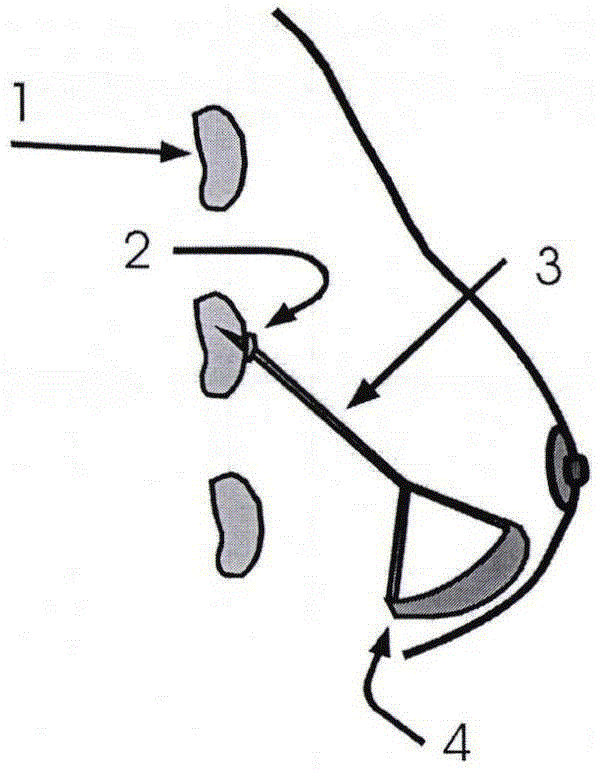 微創(chuàng)乳房體內植入裝置系統(tǒng)和工具組合的制作方法附圖